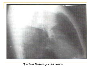 Opacidad limitada por las cisuras. 