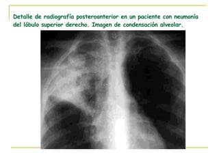 Detalle de radiografía posteroanterior en un paciente con neumonía del lóbulo superior derecho. Imagen de condensación alveolar. 