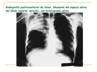 Radiografía posteroanterior de tórax. Neumonía del espacio aéreo del lóbulo superior derecho, con broncograma aéreo. 