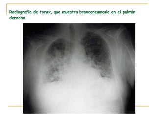 Radiografía de torax, que muestra bronconeumonía en el pulmón derecho. 
