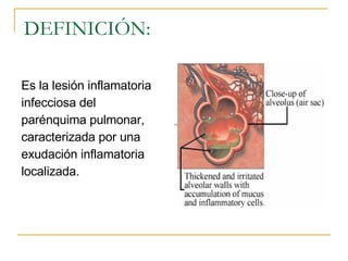 DEFINICIÓN: Es la lesión inflamatoria infecciosa del  parénquima pulmonar,  caracterizada por una  exudación inflamatoria  localizada.  