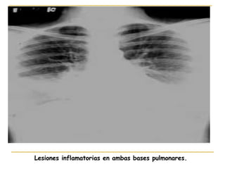 Lesiones inflamatorias en ambas bases pulmonares.  
