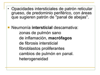 Opacidades intersticiales de patrón reticular grueso, de predominio periférico, con áreas que sugieren patrón de "panal de abejas". Neumonía  intersticial  descamativa :  zonas de pulmón sano de inflamación,  macrófagos   de fibrosis intersticial  fibroblastos proliferantes  cambios de pulmón en panal.  heterogeneidad 