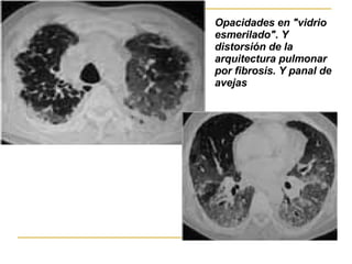 Opacidades en "vidrio esmerilado". Y   distorsión de la arquitectura pulmonar por fibrosis.  Y panal de avejas 