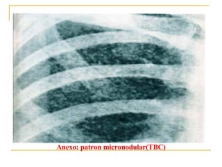                                           Anexo:  patron micronodular (TBC) 
