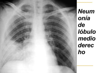 Neumonía de lóbulo medio derecho   