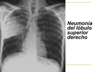 Neumonía del lóbulo superior derecho   