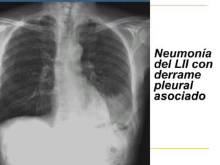 Neumonía del LII con derrame pleural asociado   