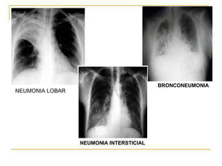 NEUMONIA LOBAR  NEUMONIA INTERSTICIAL BRONCONEUMONIA  