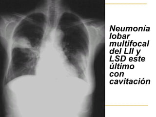 Neumonía lobar multifocal del LII y LSD este último con cavitación   