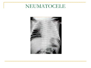 NEUMATOCELE 
