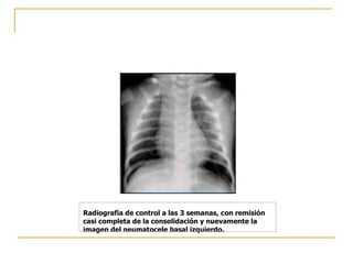 Radiografía de control a las 3 semanas, con remisión casi completa de la consolidación y nuevamente la imagen del neumatocele basal izquierdo.   