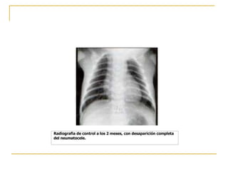 Radiografia de control a los 2 meses, con desaparición completa del neumatocele.   
