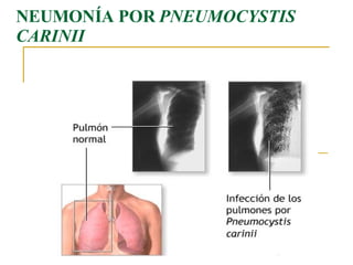 NEUMONÍA POR  PNEUMOCYSTIS CARINII 