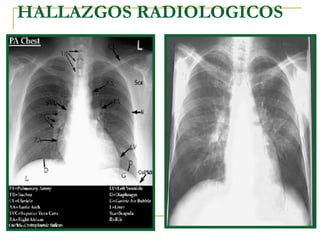 HALLAZGOS RADIOLOGICOS 