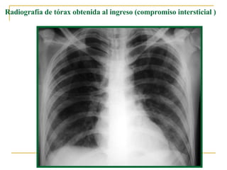 Radiografía de tórax obtenida al ingreso (compromiso intersticial   )  