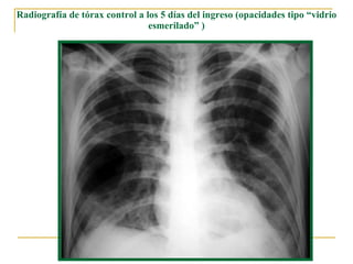 Radiografía de tórax control a los 5 días del ingreso (opacidades tipo “vidrio esmerilado” ) 