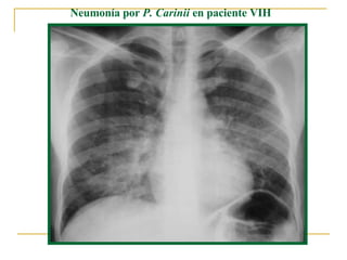 Neumonía por  P. Carinii  en paciente VIH  
