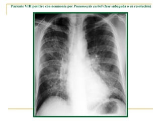 Paciente VIH positivo con neumonía por  Pneumocytis carinii  (fase subaguda o en resolución)  