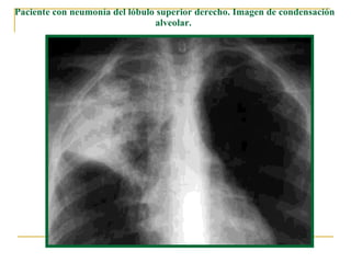 Paciente con neumonía del lóbulo superior derecho. Imagen de condensación alveolar. 