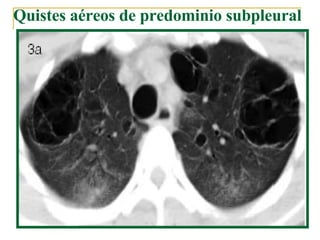 Quistes aéreos de predominio subpleural  