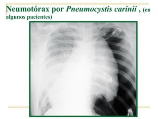 Neumotórax por  Pneumocystis carinii  ,  (en algunos pacientes) 