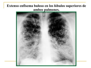 Extenso enfisema buloso en los lóbulos superiores de ambos pulmones. 