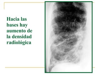 Hacia las bases hay aumento de la densidad radiológica  