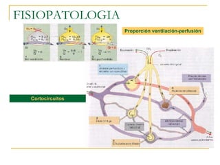 FISIOPATOLOGIA Proporción ventilación-perfusión Cortocircuitos 