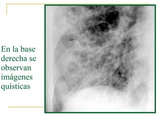 En la base derecha se observan imágenes quísticas  