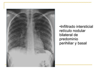 Infiltrado intersticial retículo nodular bilateral de predominio perihiliar y basal 
