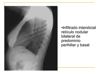 Infiltrado intersticial retículo nodular bilateral de predominio perihiliar y basal 
