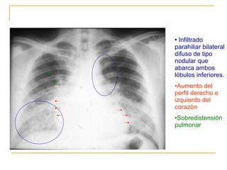 Infiltrado parahiliar bilateral difuso de tipo nodular que abarca ambos lóbulos inferiores. Aumento del perfil derecho e izquierdo del corazón Sobredistensión pulmonar 
