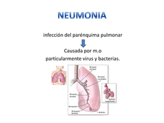 Neumonia pediatria