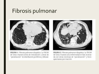Fibrosis pulmonar
 