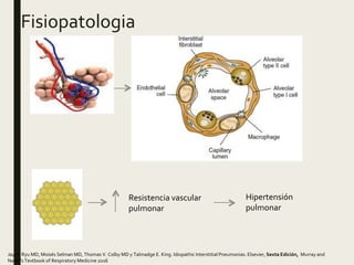Fisiopatologia
Resistencia vascular
pulmonar
Hipertensión
pulmonar
Jay H. Ryu MD, Moisés Selman MD, Thomas V. Colby MD y Talmadge E. King. Idiopathic Interstitial Pneumonias. Elsevier, Sexta Edición, Murray and
Nadel's Textbook of Respiratory Medicine 2016
 