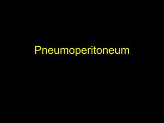 Pneumoperitoneum
 