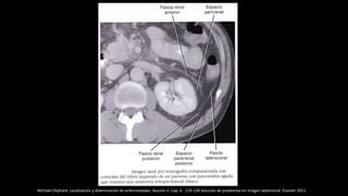 Michael Oliphant. Localización y diseminación de enfermedades. Sección II. Cap. 6 . 119-139.Solución de problemas en imagen abdominal. Elseiver 2011
 