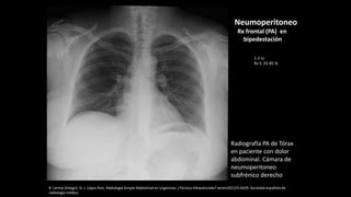 Radiografía PA de Tórax
en paciente con dolor
abdominal. Cámara de
neumoperitoneo
subfrénico derecho
R. Lerma Ortega1, D. J. López Ruiz. Radiología Simple Abdominal en Urgencias: ¿Técnica infravalorada? seram2012/S-0429. Sociedad española de
radiología médica
Neumoperitoneo
Rx frontal (PA) en
bipedestación
1-2 cc
Rx S: 55-85 %
 