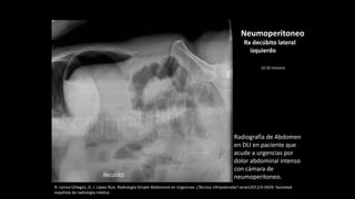 Radiografía de Abdomen
en DLI en paciente que
acude a urgencias por
dolor abdominal intenso
con cámara de
neumoperitoneo.
R. Lerma Ortega1, D. J. López Ruiz. Radiología Simple Abdominal en Urgencias: ¿Técnica infravalorada? seram2012/S-0429. Sociedad
española de radiología médica
Neumoperitoneo
Rx decúbito lateral
izquierdo
10-20 minutos
 