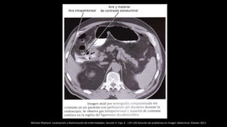 Michael Oliphant. Localización y diseminación de enfermedades. Sección II. Cap. 6 . 119-139.Solución de problemas en imagen abdominal. Elseiver 2011
 