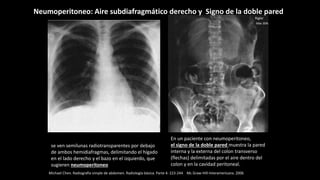 se ven semilunas radiotransparentes por debajo
de ambos hemidiafragmas, delimitando el hígado
en el lado derecho y el bazo en el izquierdo, que
sugieren neumoperitoneo
En un paciente con neumoperitoneo,
el signo de la doble pared muestra la pared
interna y la externa del colon transverso
(flechas) delimitadas por el aire dentro del
colon y en la cavidad peritoneal.
Michael Chen. Radiografía simple de abdomen. Radiología básica. Parte 4: 223-244 Mc Graw-Hill-Interamericana. 2006
Neumoperitoneo: Aire subdiafragmático derecho y Signo de la doble pared
Rigler
Más 30%
 