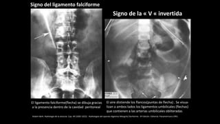 Signo del ligamento falciforme
Signo de la « V « invertida
El ligamento falciforme(flecha) se dibuja gracias
a la presencia dentro de la cavidad peritoneal
El aire distiende los flancos(puntas de flecha) . Se visua-
lizan a ambos lados los ligamentos umbilicales (flechas)
que contienen a las arterias umbilicales obliteradas
Robert Berk. Radiología de la vesícula. Cap. 49 (1005-1022) . Radiologías del aparato digestivo Margulis/ Burhenne. 4º Edición. Editorial. Panamericana.1991.
 