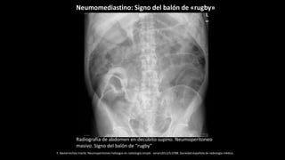 Radiografía de abdomen en decúbito supino. Neumoperitoneo
masivo. Signo del balón de "rugby"
F. Basterrechea Iriarte. Neumoperitoneo hallazgos en radiología simple . seram2012/S-0788 .Sociedad española de radiología médica.
Neumomediastino: Signo del balón de «rugby»
 
