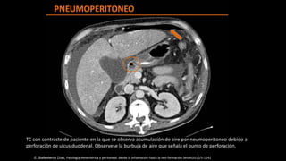 TC con contraste de paciente en la que se observa acumulación de aire por neumoperitoneo debido a
perforación de ulcus duodenal. Obsérvese la burbuja de aire que señala el punto de perforación.
E. Ballesteros Díaz, Patología mesentérica y peritoneal: desde la inflamación hasta la neo formación Seram2012/S-1242
 