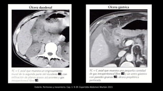 Federle. Peritoneo y mesenterio. Cap. 1: 9-39. Expertddx Abdomen Marbán 2015
 