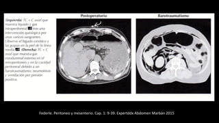 Federle. Peritoneo y mesenterio. Cap. 1: 9-39. Expertddx Abdomen Marbán 2015
 