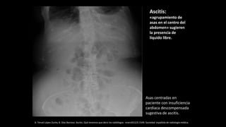 Asas centradas en
paciente con insuficiencia
cardiaca descompensada
sugestiva de ascitis.
Ascitis:
«agrupamiento de
asas en el centro del
abdomen» sugieren
la presencia de
líquido libre.
A. Teruel López Zurita, B. Díaz Barroso. Ascitis: Qué tenemos que decir los radiólogos. eram2012/S-1549. Sociedad española de radiología médica.
 