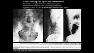 Jaume Llauger, Carmen Pérez. Abdomen: Peritoneo, epiplón y mesenterio. Pedrosa diagnóstico por imagen. Tratado de Radiología. Volumen
II. Cap. 36 (103-145)-Mc Graw-Hill-Interamericana.1986
Ascitis: Semiología del líquido libre intraperitoneal
Borramiento o desplazamiento medial del ángulo hepático.
Desplazamiento medial del colon ascendente y descendente.
Signo de las orejas de perro. Aumento de la densidad en la pelvis
 