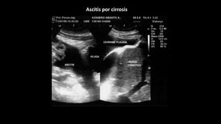 Ascitis por cirrosis
 